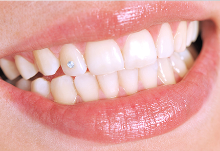 審美的歯科処置で美しい歯を手に入れる