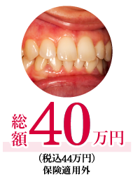 コルチコトミー片顎