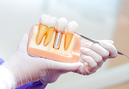 インプラントと他の治療法をくらべました