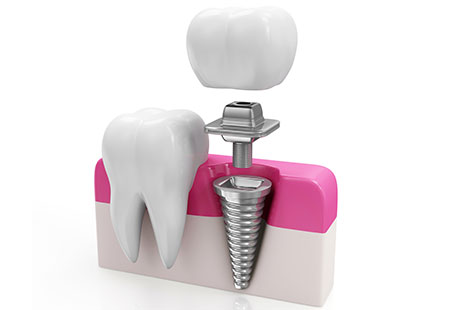 インプラント治療