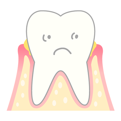 歯肉炎・軽度歯周炎