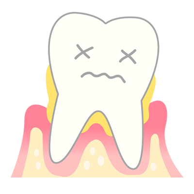 重度歯周炎