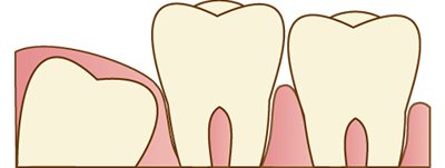親知らずは早めに治療しましょう