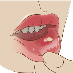 口内炎