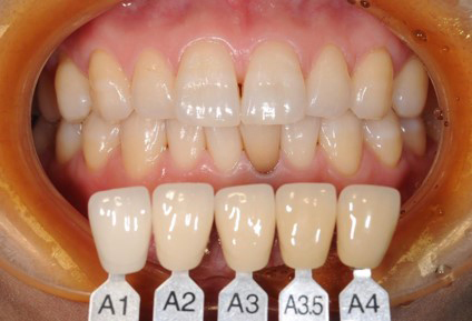 PICKUP 矯正治療を受けられる方はホワイトニング1回分を無料でお試しいただけます