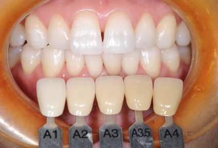 PICKUP 矯正治療を受けられる方はホワイトニング1回分を無料でお試しいただけます